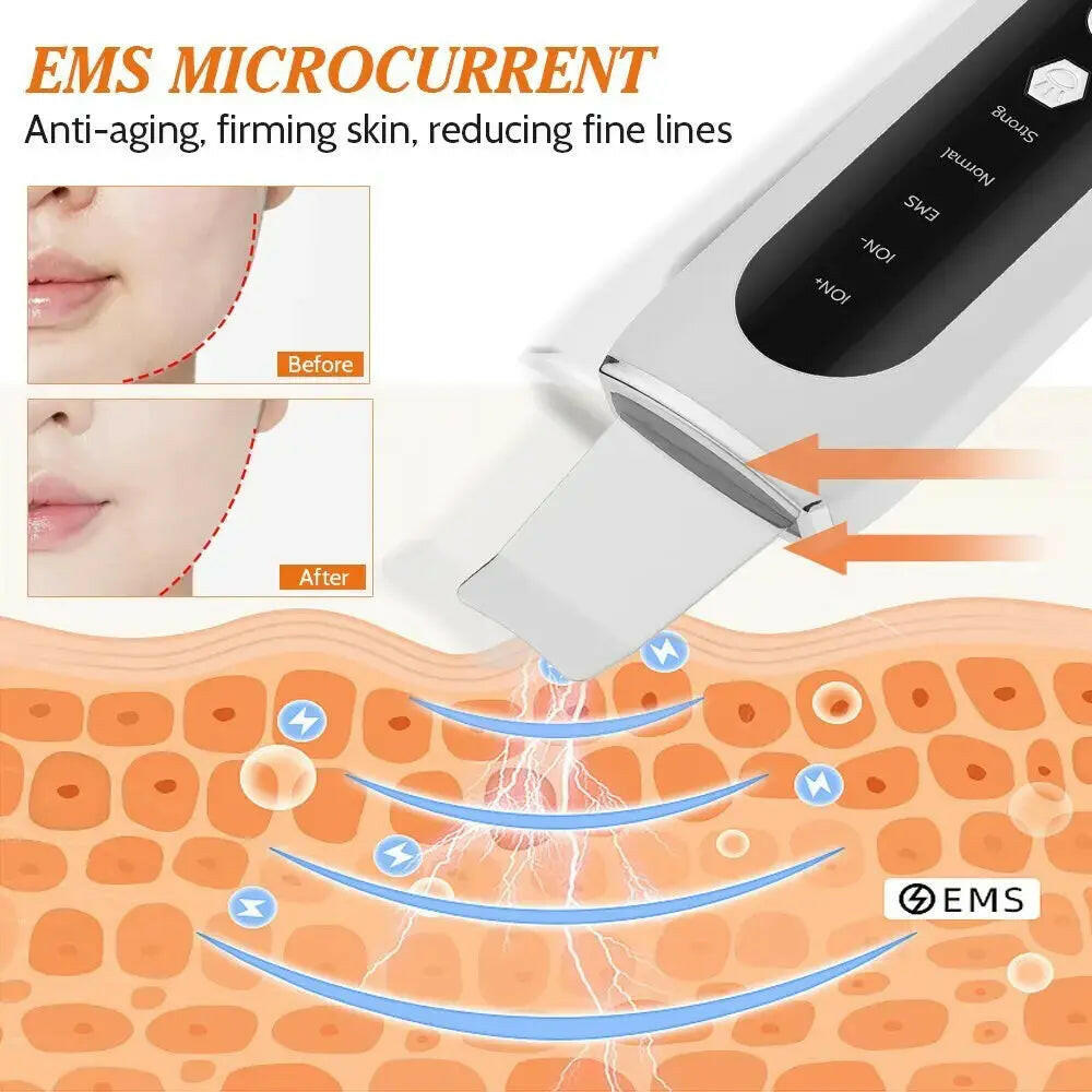 Ultrasonic Skin Scrubber and Blackhead Remover for Deep Facial Cleaning - RtrStore